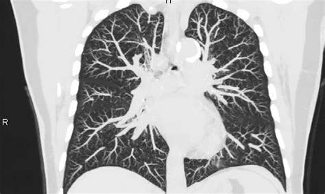 TAC polmonare con noduli