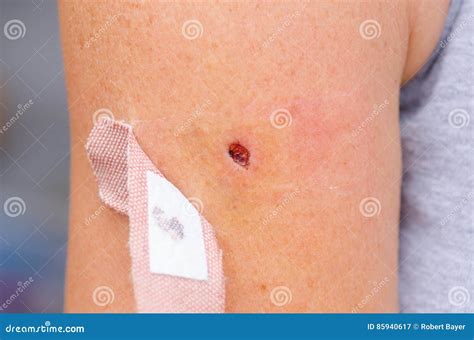 Evoluzione della pelle dopo crioterapia: formazione di crosta