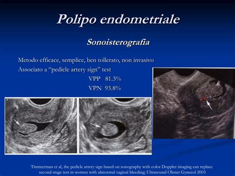 Microscopio che mostra tessuto endometriale con un polipo