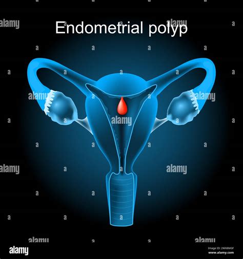 Diagramma dell'utero che mostra la posizione di un polipo endometriale