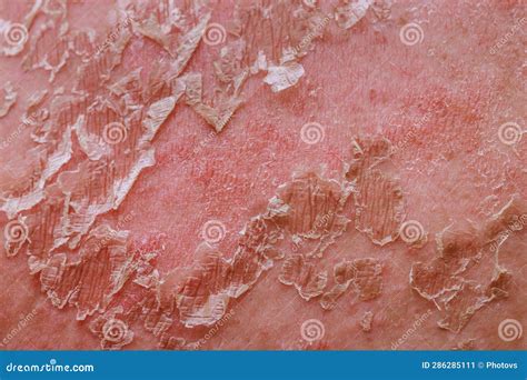 pelle irritata dopo depilazione