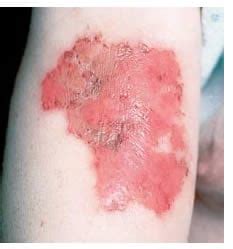 Illustrazione delle varie cause di escoriazione cutanea