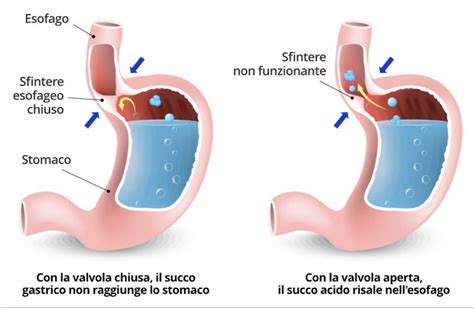 Schema anatomico dell'esofago e dello stomaco con indicazione dello sfintere esofageo inferiore