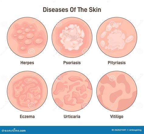 Diverse condizioni della pelle: acne, eczema, psoriasi